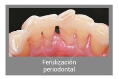 Interlig Fibra De Vidrio Trenzada Angelus - Ituren Odontología