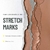 Idraet - Stretch Marks Serum Reparador Intensivo de Estrias (100ml) - Casiopea Beauty Store