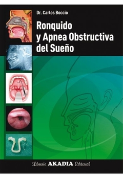 Ronquido y apnea obstructiva del sueño - Boccio