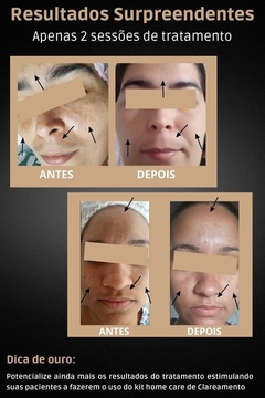 Resultados antes e depois do peeling egípcio - Kit profissional para clareamento da pele