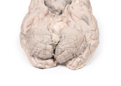 Modelo 3D de Meningioma na internet