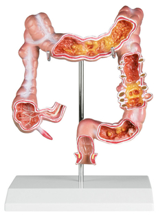 Modelo Anatômico de Cólon com Patologias