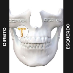 Placa 2,0 Standard - Ancoragem Trava Fio T 3 Furos - G & M orthodontics equipamentos ortodonticos LTDA