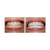 2 Seringas Clareador Dental Perfect 16% +1 Moldeira e Estojo - loja online