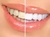 Clareador Dental Whiteness Simple 22% - FGM - 9 Un + 2 Pares de Moldeiras na internet
