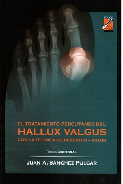 El tratamiento percutáneo del Hallux Valgus con la técnica de Reverdin-Isham