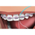 Passa Fio Condutor de Fio Dental Para Aparelho Ortodôntico Fixo 30 ou 60 Unidades- Lysanda vi na internet