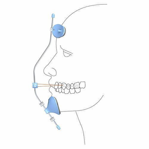Máscara facial de ortodoncia, ¿para qué sirve?, Solución Dental