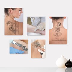 Kit 5 Placas Decorativas - Remoção Tatuagem Tattoo Casa Quarto Sala - 131ktpl5