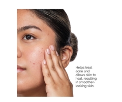 The Ordinary the acne set: 3 step regimen - tienda en línea